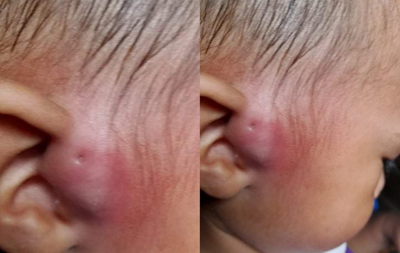 phẫu thuật rò luân nhĩ hết bao nhiêu tiền 1