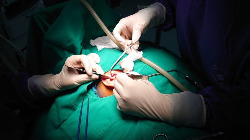 phẫu thuật rò luân nhĩ hết bao nhiêu tiền 2