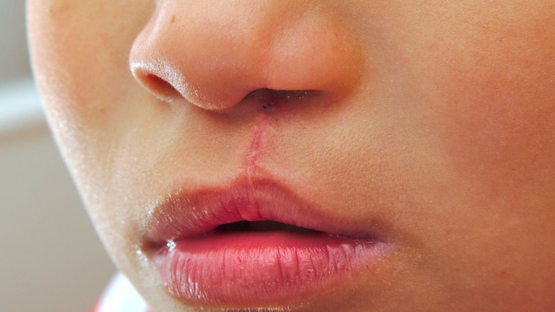 Thời điểm phẫu thuật phụ thuộc vào tình trạng và độ tuổi của trẻ