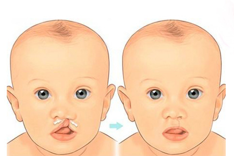 Phẫu thuật sứt môi: Những điều cần biết 2