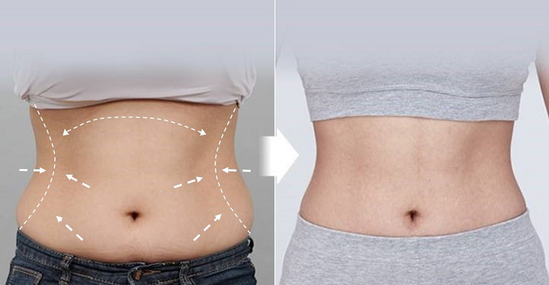 Phẫu thuật tạo hình thành bụng và những điều cần biết 3