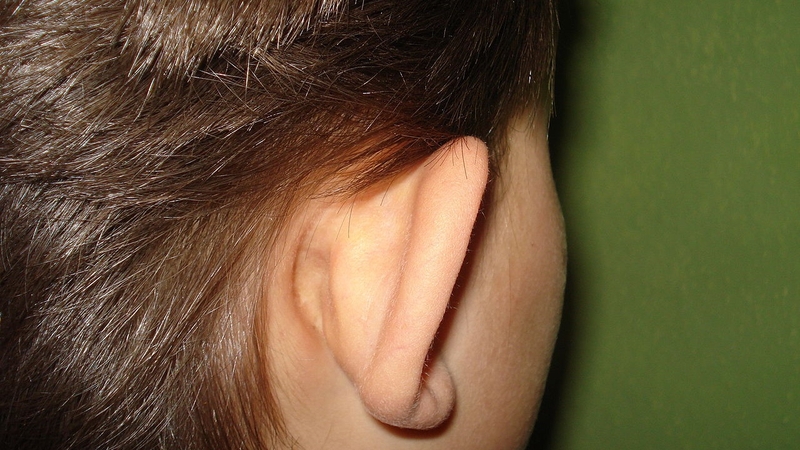 Phẫu thuật tiệt căn xương chũm là gì? Quy trình thực hiện như thế nào? 5