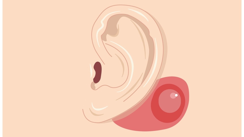 Phẫu thuật tiệt căn xương chũm là gì? Quy trình thực hiện như thế nào? 1