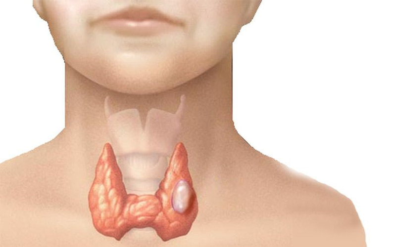 Phẫu thuật tuyến giáp có nguy hiểm không? 3