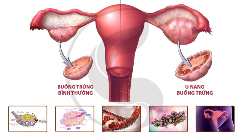 Phẫu thuật u nang buồng trứng và những điều cần biết 3