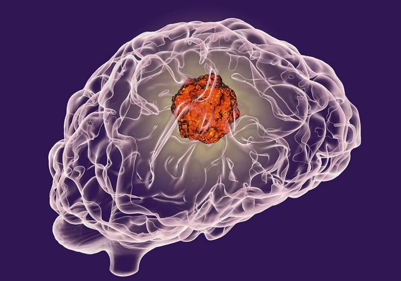 Phẫu thuật u tuyến tùng và cách chăm sóc người bệnh sau phẫu thuật u tuyến tùng 1