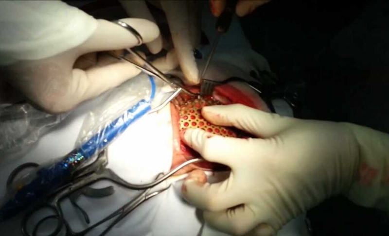 Phẫu thuật vá khuyết sọ và các phương pháp phẫu thuật vá khuyết sọ 3