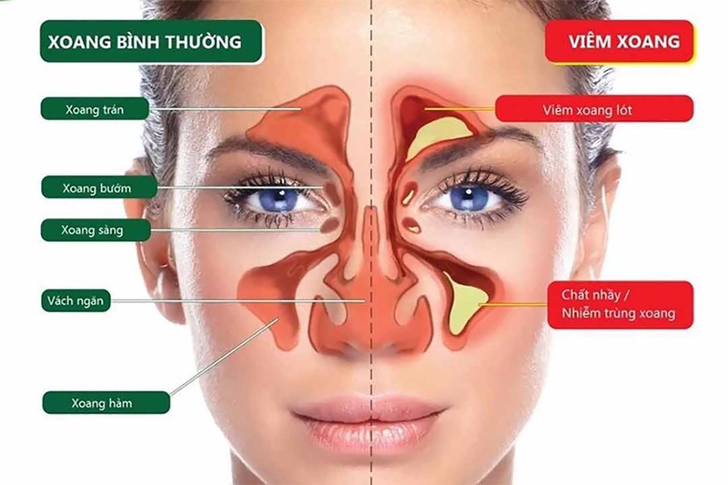 Phẫu thuật viêm xoang và những điều cần biết 2