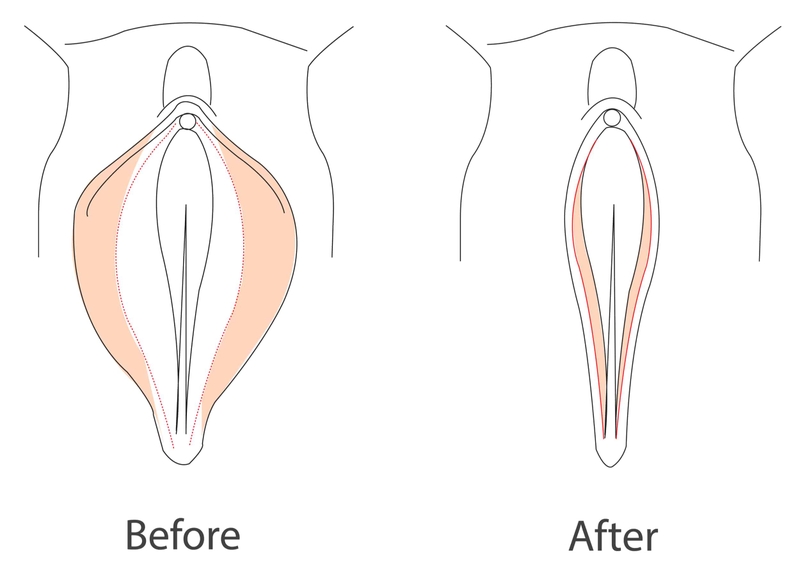 Phẫu thuật vùng kín và những điều cần biết 3