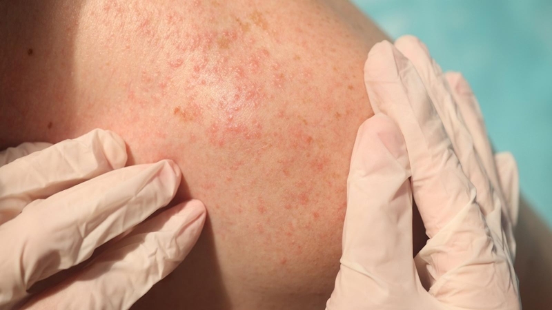 Phenol peel là gì? Công dụng và một số điều cần lưu ý 2