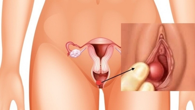 Phì đại âm vật là gì? Cách điều trị ra sao? 1