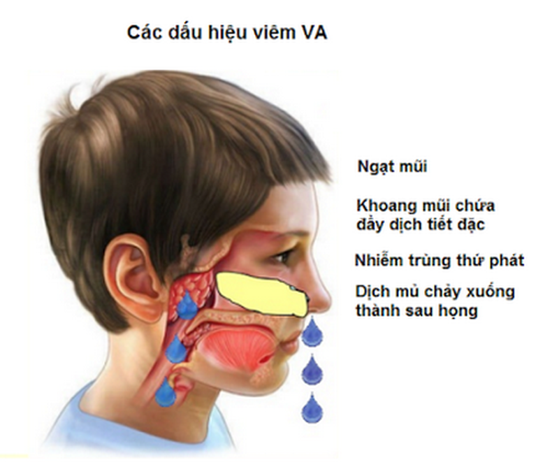 Các dấu hiệu phì đại VA