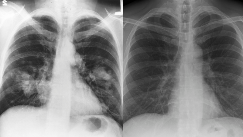 Hình ảnh phổi trắng khi chụp X-quang