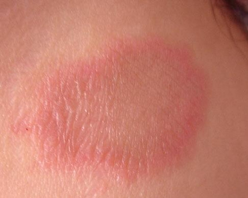 Các cách phòng chống bệnh vảy nến hiệu quả nhất 1