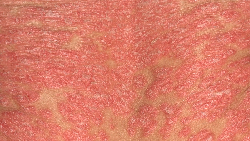 Các cách phòng chống bệnh vảy nến hiệu quả nhất 2