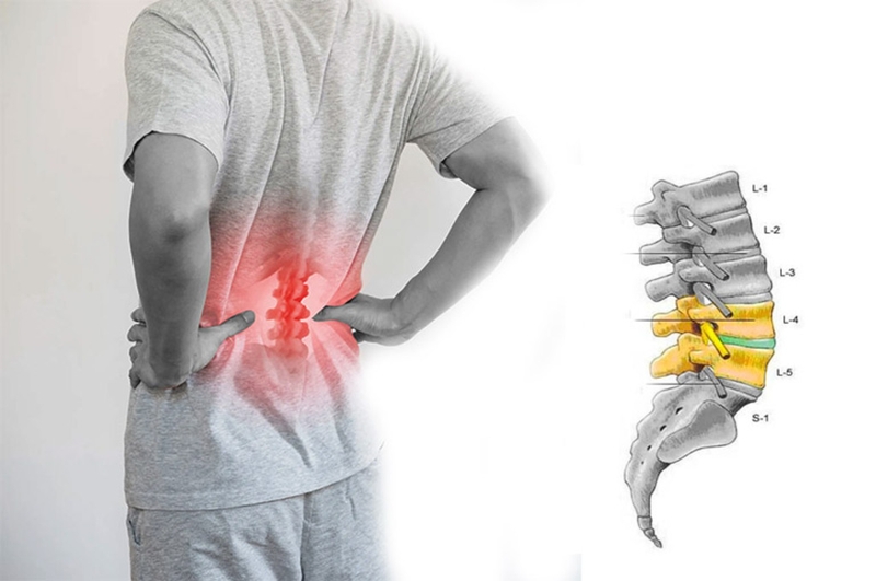 Phồng đĩa đệm L4/L5 là gì? Bệnh phồng đĩa đệm L4/L5 có chữa được không? 1