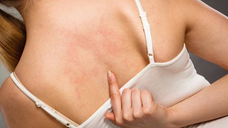 Phòng ngừa chàm eczema như thế nào 3