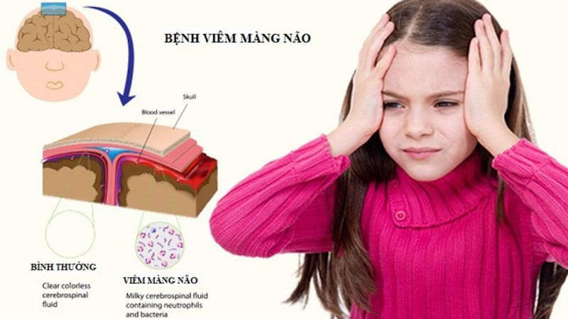 phòng tránh viêm màng não tái phát 1