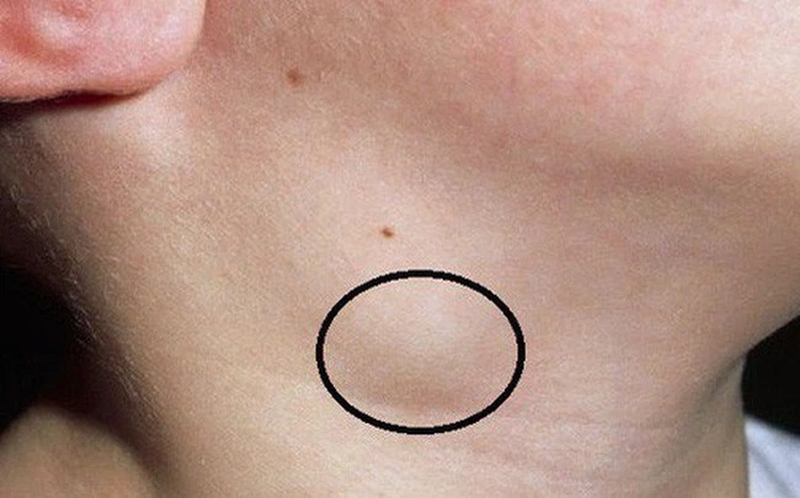 Những điều cần biết về phù bạch huyết ở bệnh nhân ung thư2