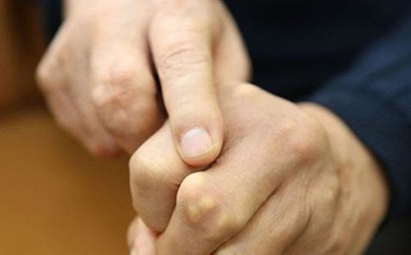 Triệu chứng gout cấp, nguyên nhân và cách chữa trị 2