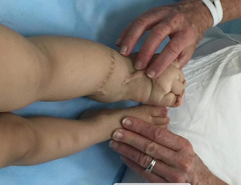 Những điều cần biết về phù bạch huyết ở bệnh nhân ung thư1