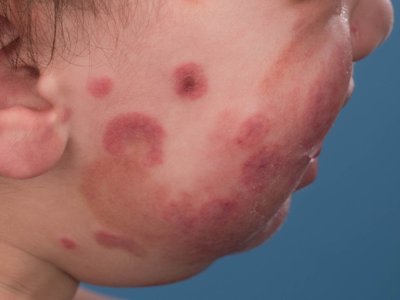 Phù nề xuất huyết cấp tính - căn bệnh lần đầu xuất hiện tại Việt Nam 1