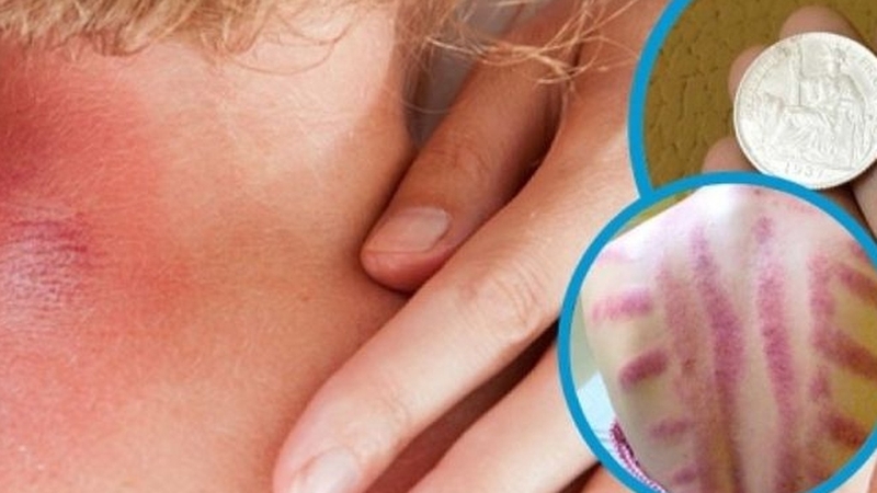 Phụ nữ đang có kinh cạo gió được không? Hiểu rõ tác dụng và lời khuyên an toàn 2