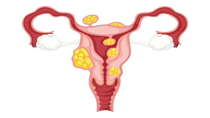 Phụ nữ mắc u xơ tử cung có sinh thường được không? 1