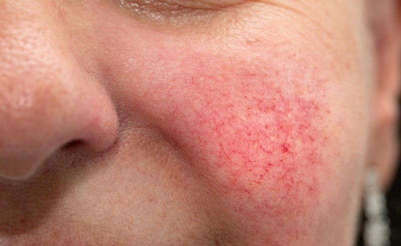 Da nhiễm corticoid biểu hiện thế nào? Cách phục hồi da nhiễm corticoid 2