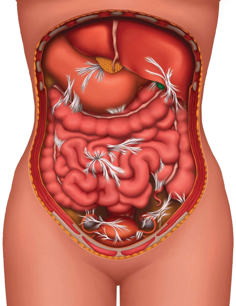 Phúc mạc là gì? Nguyên nhân gây viêm phúc mạc 4