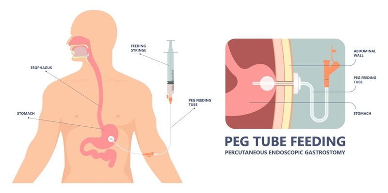 Phúc mạc là gì? Nguyên nhân gây viêm phúc mạc 5