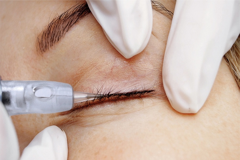 Phun mí mở tròng mắt không xâm lấn sâu gây đau