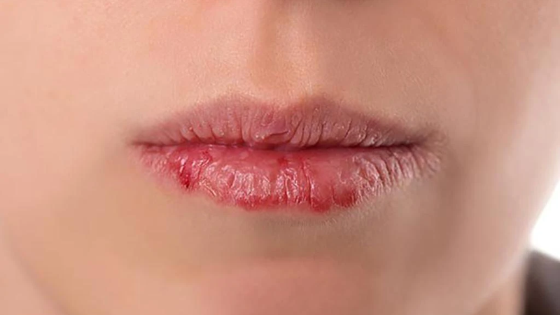 Phun môi 3 ngày đã bong có thể do nhiều nguyên nhân khác nhau