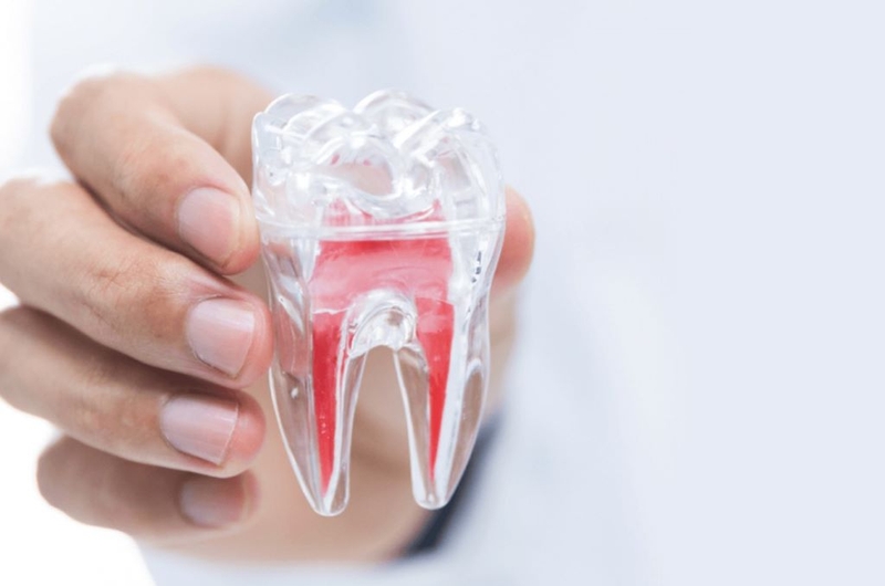 Phương pháp bọc răng sứ có cần lấy tủy không? Ưu điểm của kỹ thuật mà người dùng nên biết 2