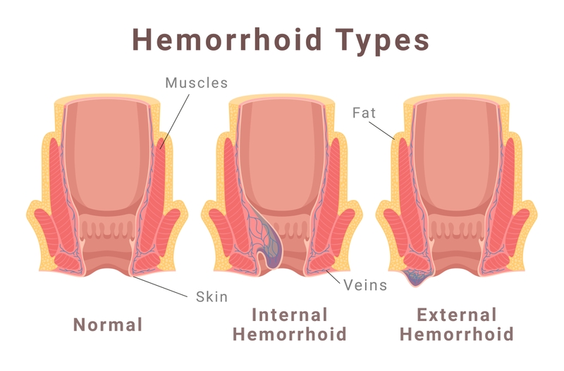 Phương pháp cắt trĩ milligan morgan là gì?2