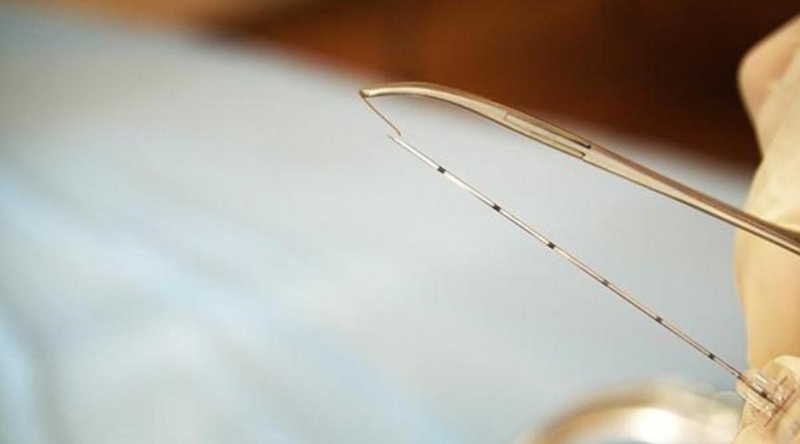 Phương pháp cấy chỉ chữa bệnh xương khớp 1