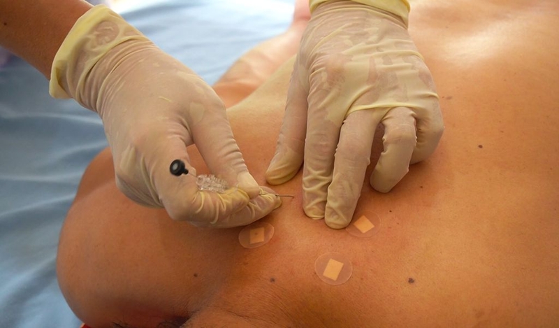 Phương pháp cấy chỉ điều trị thoát vị đĩa đệm có tốt không? 2