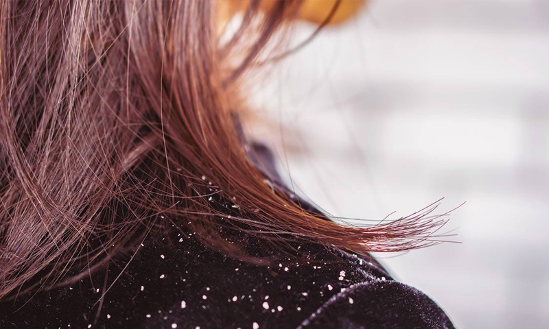 Phương pháp chăm sóc tóc gàu đúng cách giúp đánh bay gàu hiệu quả 2