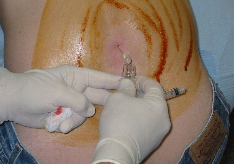 Phương pháp chẩn đoán và điều trị huyết khối tĩnh mạch nội sọ 3