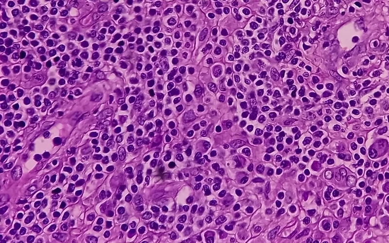 Phương pháp chẩn đoán và hướng điều trị hội chứng mô bào ở trẻ em 2