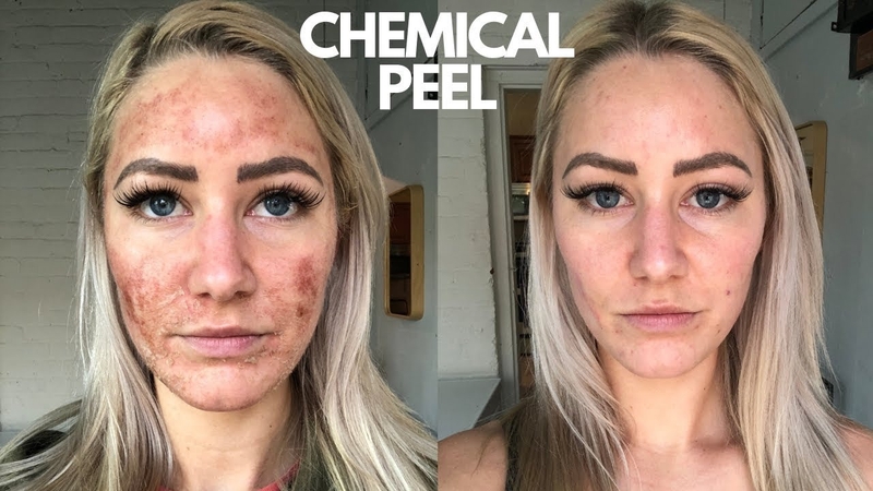 Phương pháp Chemical Peel trị mụn cực kỳ hiệu quả 1