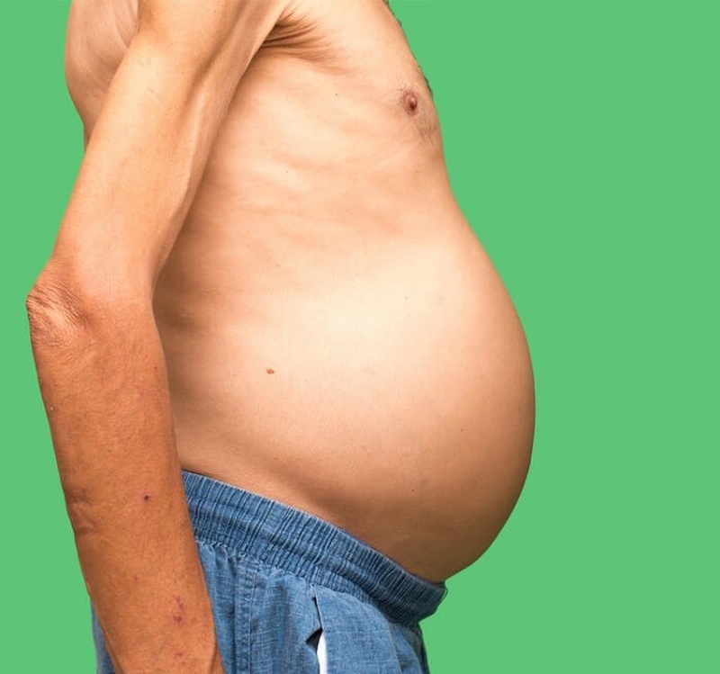 Phương pháp chữa bệnh xơ gan cổ trướng giai đoạn cuối1