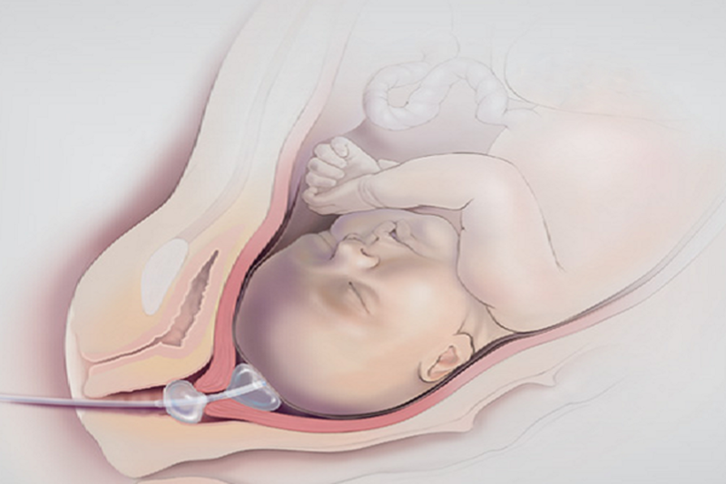 phuong-phap-dat-bong-kich-de-bao-lau-thi-sinh 3.png