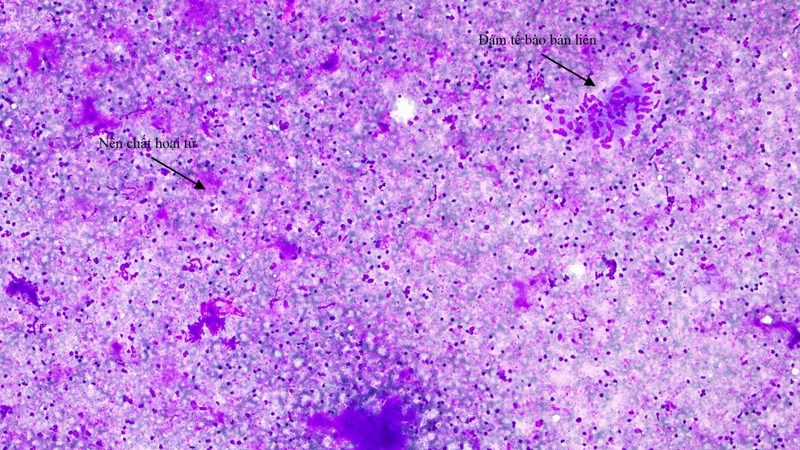 Phương pháp điều trị bệnh lao hạch cổ 1