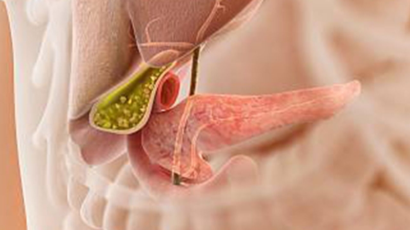 Sỏi mật nếu không được phát hiện sớm, bệnh có thể dẫn đến những biến chứng nguy hiểm
