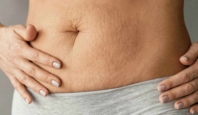 Phương pháp điều trị tình trạng căng da bụng hiệu quả 2