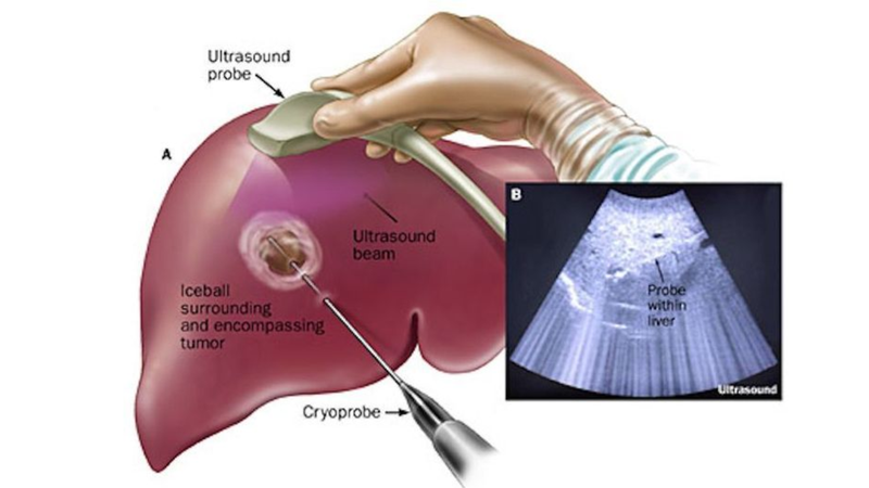Xạ trị ung thư gan và một số phương pháp điều trị ung thư gan khác 3