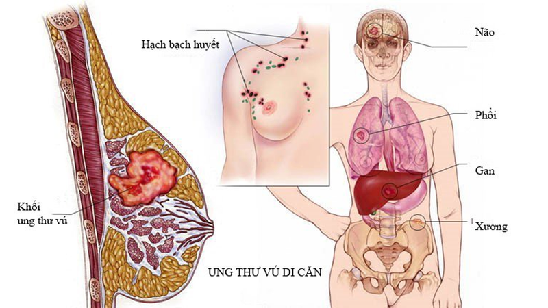 Ung thư vú di căn phổi