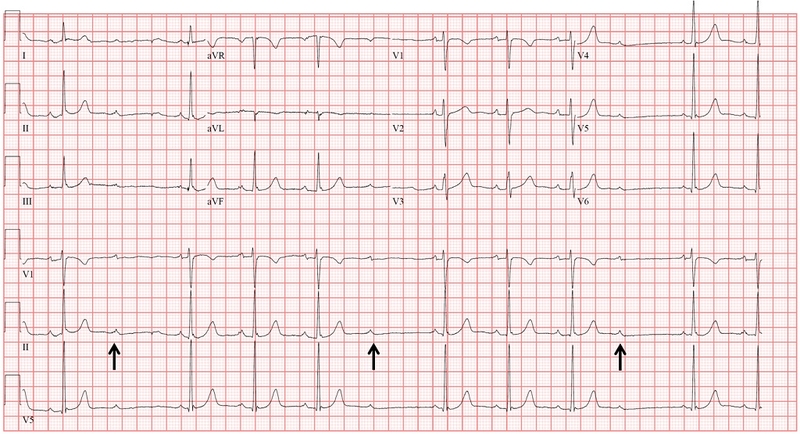 Phương pháp đo ECG là gì? Nguyên lý và quy trình các bước đo ECG 2