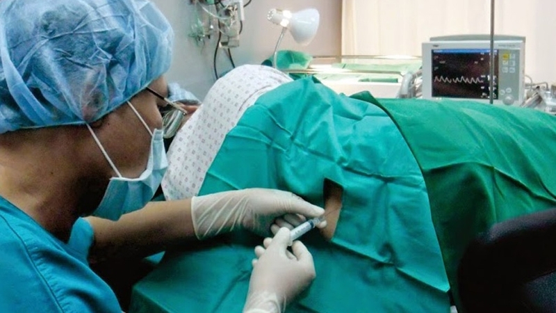 Phương pháp gây tê CSE là gì? Giải pháp an toàn và hiệu quả cho phẫu thuật 4